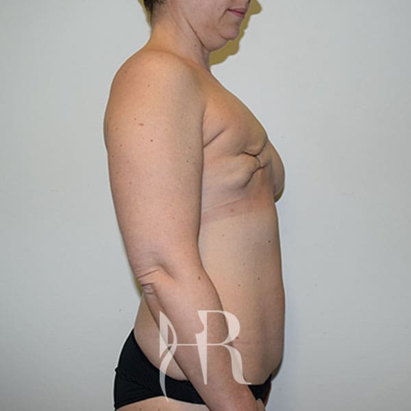 HR Plastic Surgery - Breast Reconstruction patient before 5